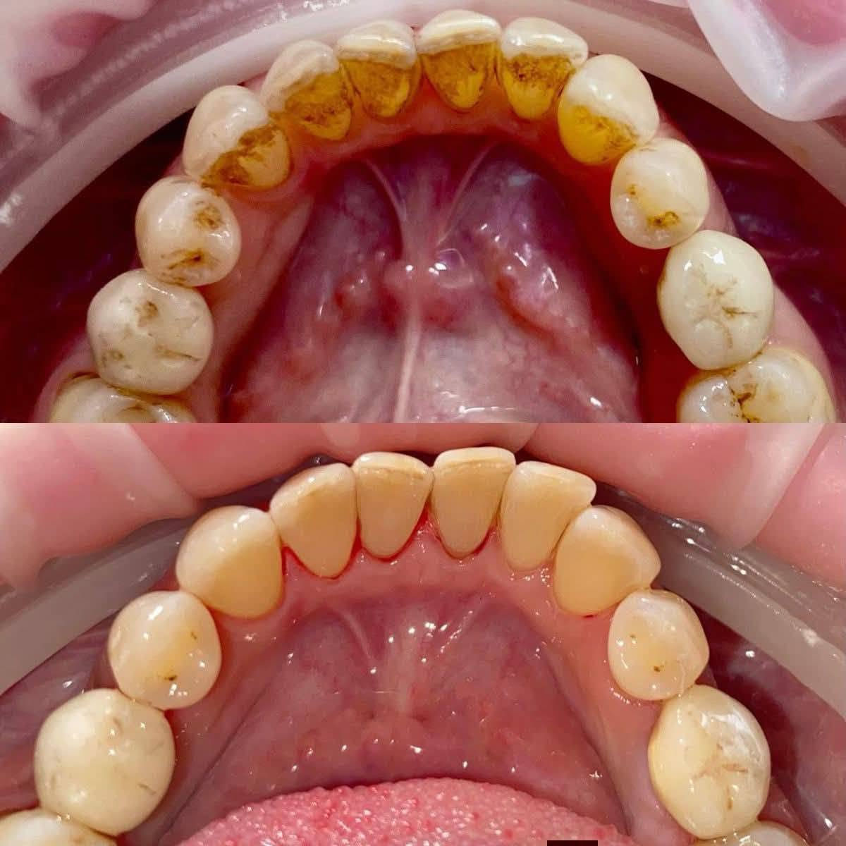 عروض الجمعه تنضيف أسنان ب20 فقط بدل 50 
الحجز على الرقم التالي ***********

نص مكتوب في الصور:
- Spudak dental group