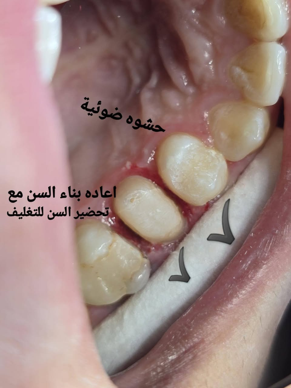 اعاده بناء السن مع تغليف السن ( زاركون)
عياده الاسكندريه لطب وتجميل الاسنان 
العنوان/ الاسكندريه ، خلف دائره الكهرباء ( مجمع الدكتور خالد عبد الخضر).
للحجز والاستفسار مراسله صفحه العياده او الاتصال على الرقم: 
***********
متواجدين يوميا من ٣ عصرا إلى ٩ باليل 

انستا العياده
 https://www.instagram.com/alexandria_clinic88?igsh=cjNtdWlmdWR1ODVu
الفيس 
https://www.facebook.com/share/1D2WrWPzQc/
