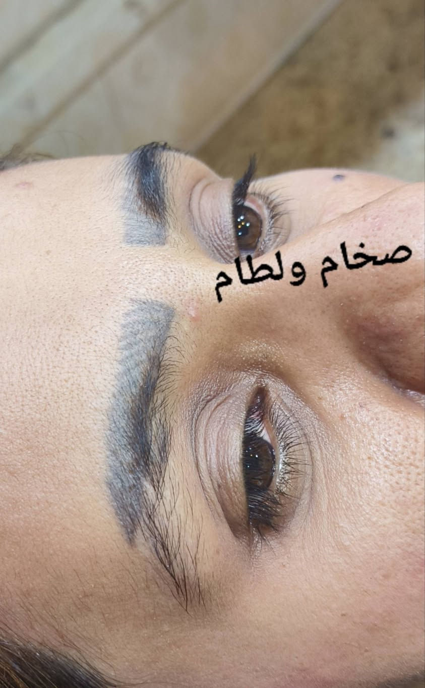 ازالة تاتو • ٣ جلسات • السماوه الحسين