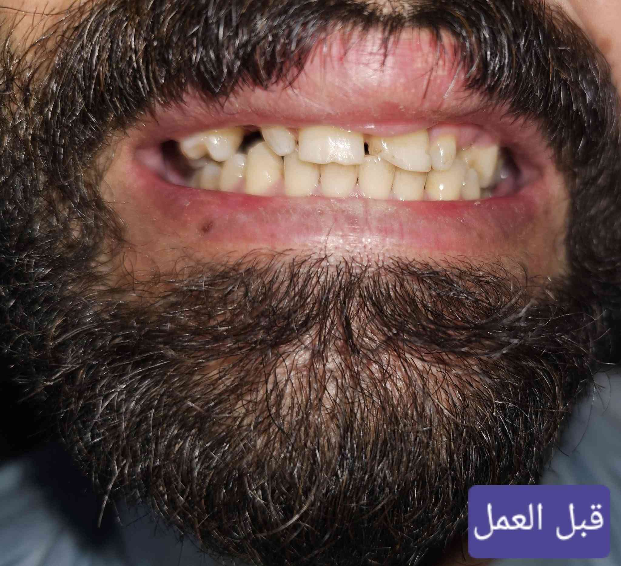 مراجع يعاني من فقدان وعدم انتظام الاسنان ...تم عمل خطة علاجية واكساء الاسنان بتركيبات الزاركون الثابتة ليكتسب ابتسامة رائعة ومشرقة 
د.مريم شاكر محمود 
للحجز ☎️☎️واتس ***********
حي الفارس /الشارع الرئيسي/قرب محطة وقود الفارس /مقابل اسواق جدو🦷🤍
