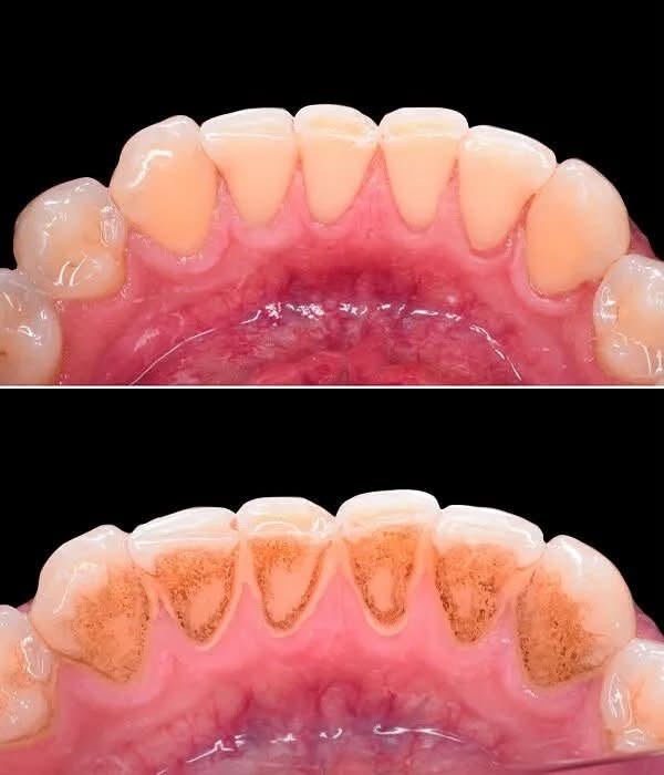 حشوات تجميلية • تنظيف أسنان • شبه مجانية