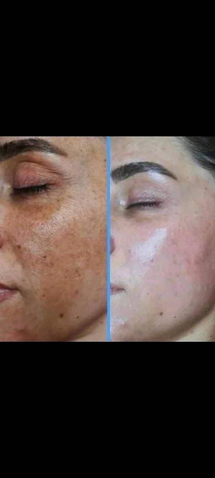كلف • تصبغات • كريمين