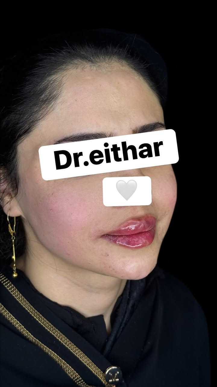 استداره الوجه كامله (لفتنك وجنات واصداغ وتدوير الفك والذقن ونظاره) والشفة🔥🔥

عروووض فرحة الزهره ثبتتهه الكم بالستوري بالهايلايت وببوست اعلى الصفحة ✨✨

د.ايثار سامي عبد الامير
واسط الكوت الهوره مجمع القبطان طابق اول 

الحجز***********
