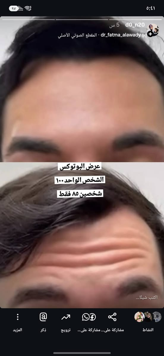 قسم التجميل 💉
السلام عليكم
على بركه اللّٰه
نعلن عن افتتاح قسم التجميل بعياداتنه الكائنه في( حي النداء شارع ٦٠)
العرض الاول للبوتوكس فقط ب85الف بدل 125
لأول5 مراجعين فقط يحصلون على جلسة البوتوكس شد الجبهة ورفع وسحبة الحاجب والتجاعيد حول العين
بوتوكس ابتسامه لثويه فقط ٥٠
بوتوكس تصغير فتحات الانف فقط ٥٠
بوتوكس صرير الاسنان ٥٠ الف فقط
بوتوكس التعرق ١٠٠ فقط
عرض الفلر لل1cc فقط 80الف بدل 100 الف الفحص والاستشاره
مجاناً
التغيير الشامل  للرجال والنساء لكل الوجه وجنات ذقن اصداغ  شفه 500 بدل 900 مع جلسه تنظيف اسنان وبلازما مجاناً
ابره الخلايا الجذعيه لتوقف تساقط الشعر وأنبات الشعر الجديد  75
يوجد أبر نضاره ومحفزات كولاجين وميزوات تفتيح وازاله
التصبغات
عليهن عروض حلوه لفتره محدوده
علما جميع المواد امنه
ومفحوصه ومسجله بوزاره الصحه
للأستفسار والحجز على الارقام الاتيه
***********
***********
