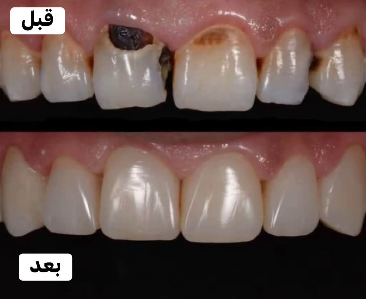 مجاني • عيادات جامعة الفارابي • حشوات/تبيض/قلع