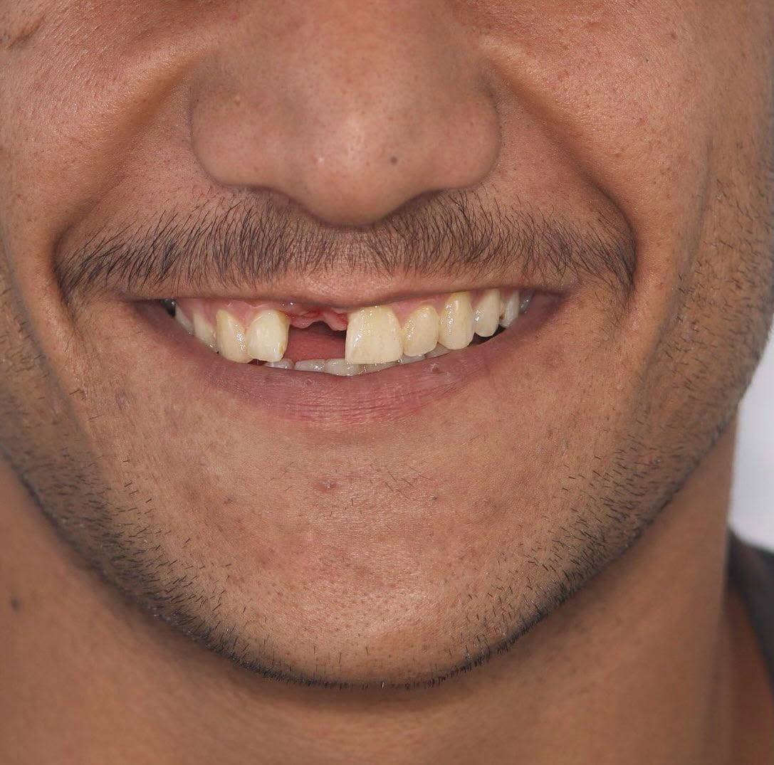 كلما چنت أريد أضحك.. چنت أغطي حلگي بـإيدي.."
في عيادتنا، ما نغير شكل الأسنان بس.. إحنا نغير جودة حياة مراجعينا ونرجع لهم الأمل.

لأن راحتكم تهمنا.. الابتسامة صارت بالتقسيط!

​💡 قصتك القادمة تبدأ بقرار.. لا تخلي التكلفة تأجل ضحكتك، 
​📞 احجز موعدك الآن واصنع قصتك الخاصة:
​
​رقم الواتساب / الهاتف: [ *********** ]
​أو ارسل لنا رسالة مباشرة على بريد الصفحة 📩
​#قصص_النجاح #طب_أسنان #ابتسامة_جديدة #مصرف_الرافدين #تسهيلات_دفع #أقساط #العراق
