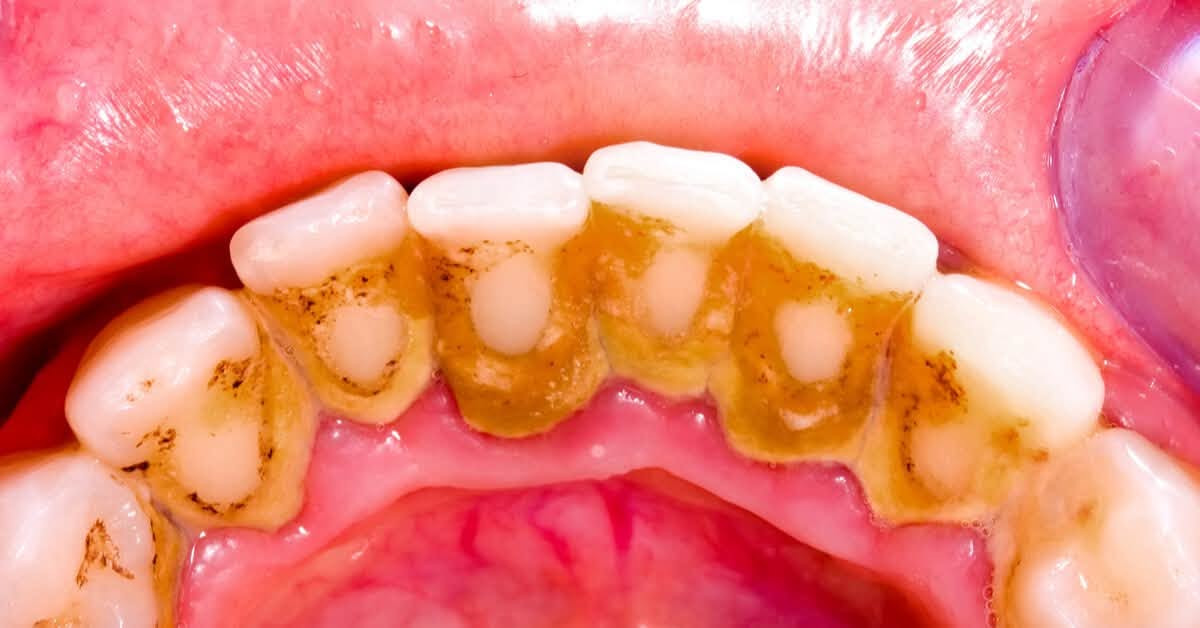 🦷 علاج أسنان مجاناً! 🤍

عندك سن يحتاج قلع؟ حشوة ضوئية؟ تنظيف تكلسات؟
أو عندك أسنان مفقودة وتحتاج طقم جزئي؟ 🦷✨

📍 العلاج في جامعة الفراهيدي – القادسية
👩🏻‍⚕️ تحت إشراف دكاترة وبشكل آمن.

✨ الخدمات:
▫️ قلع
▫️ حشوات ضوئية
▫️ تنظيف تكلسات
▫️ أطقم جزئية للأسنان المفقودة

📩 العدد محدود، واللي مهتم يراسلني خاص حتى نشوف الحالة ونحدد إذا مناسبة للعلاج.
او التواصل على الرقم ***********
🤍 لا تأجل علاج أسنانك… خلي ابتسامتك ترجع مثل قبل!
