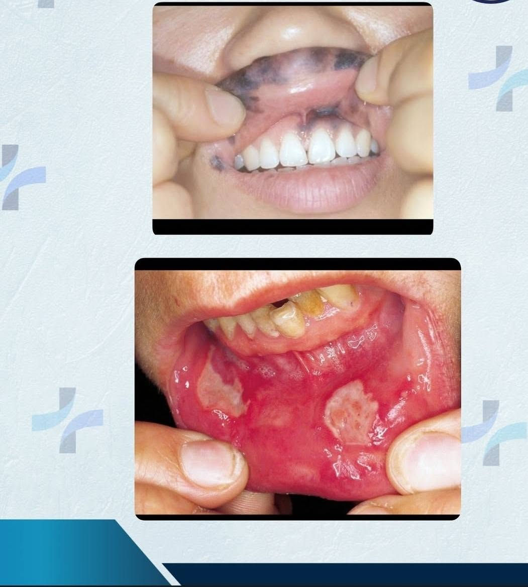 العلاج والفحص مجانا 🙌
.

زورونا في عيادات جامعة العميد في الجمعية خلف مول الحارث 
للحجز مراسلة الرقم  *********** 📞
.
⚕️الحشوات الضوئية 
⚕️تنظيف الاسنان من التكلسات 
⚕️الطقوم المتحركة 
⚕️قلع جذور الاسنان المتدمرة
