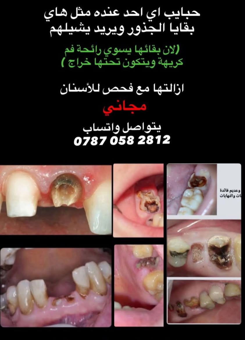 علاج أسنان مجاني • حشوة جذر • جامعة البيان