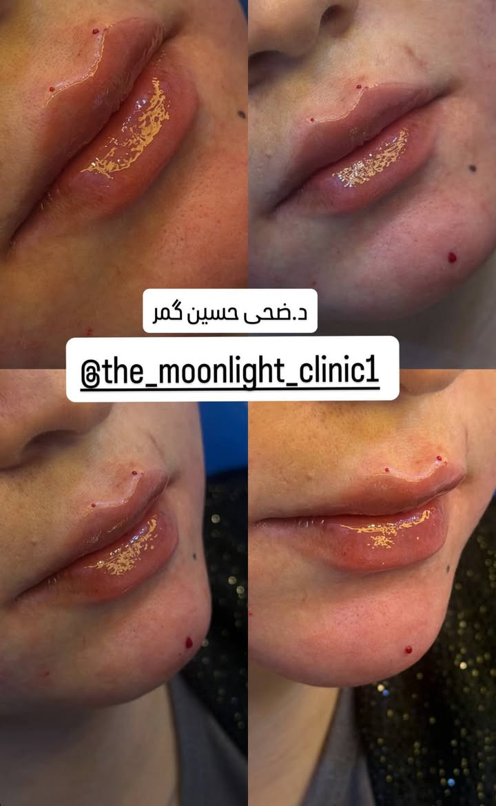 فيلر شفايف • هيالوس ايطالي • د ضحى حسين گمر
