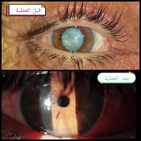 ماء أبيض • قبل اكتمال الساد • عيادة المسيب