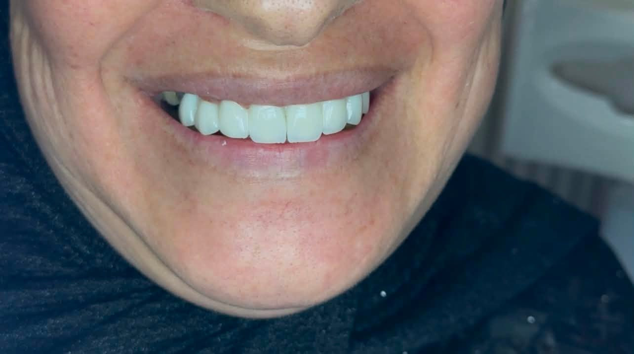 🦷✨ من ابتسامة متعبة إلى ابتسامة #أجمل 🤍

مراجعتنا كانت تعاني من تسوسات قوية وحشوات قديمة معمولة بطريقة خاطئة.

بعد معالجة #الأسنان، قمنا بعمل تغليفات بتصميم متناسق، والمراجعة حبت تختار لون شبابي يرجعلها الحيوية 🩷🌼
فاختارت #اللون حسب #رغبتها ✨

👨‍⚕️ د. عبدالوهاب حازم
📍 العنوان: #الحود مقابل تيم مارت
📞 عيادة طب الأسنان: ***********
💳 يتوفر نظام #التقسيط لتسهيل العلاج 🤍
