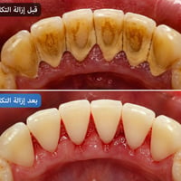 علاج اسنان • إزالة تكلسات • كلية طب الاسنان