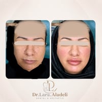 شد الوجه بالفلر • ٦ سيسي • دكتورة لارا حسين