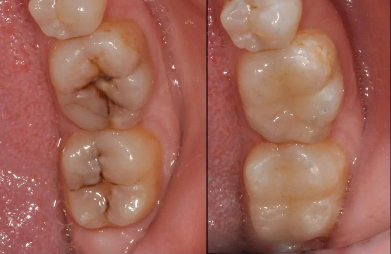 علاج مجاني بالكامل ‼️
لحالات التسوس بالحشوات التجميلية
قلع الجذور التالفة
تنظيف الاسنان من التكلسات و التصبغات 
تعويض الاسنان المفقودة بطقم متحرك 
العنوان: 
عيادات جامعة الهادي/ نهاية شارع 60
التواصل على الرقم 
***********
