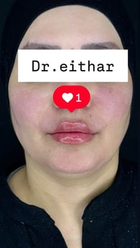 شد الوجه • فلر شفه • فلر ايطالي