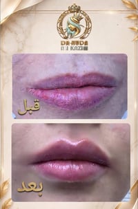 فيلر شفايف • د. هدى • ميسان سوق الذهب