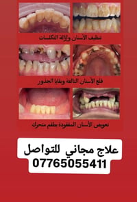 تنظيف الأسنان • قلع الأسنان • طقم متحرك