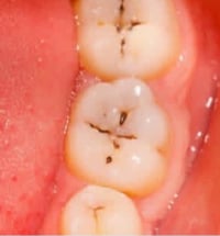 علاج مجاني • تنظيف اسنان • عيادات جامعه الكفيل
