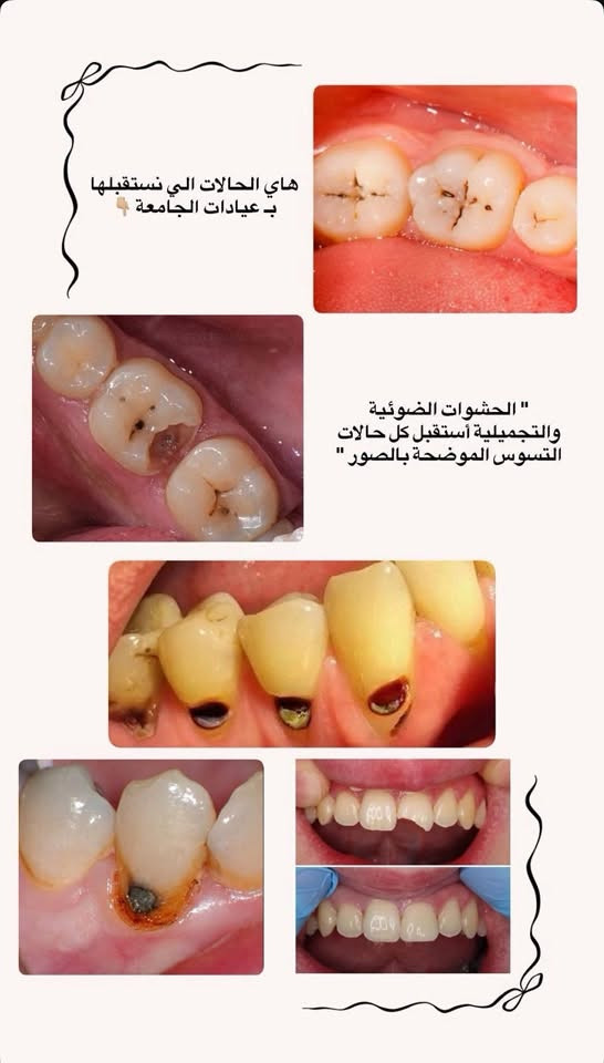 مجاني • تنظيف اسنان • حشوات ضوئية