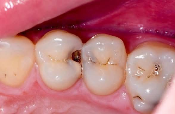 عندج هيج تسوسات؟علاجها مجاناً 🟢
📍 الموقع: عيادات طب الأسنان – جامعة كربلاء- حي الموظفين - شارع مستشفى الولادة 

📞 للتواصل والحجز: ***********

رجّع ابتسامتك وثقتك… لأن التفاصيل الصغيرة تغيّر هواي 🌿⁩
