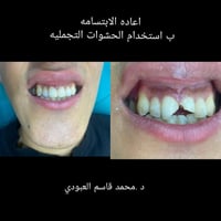 إعادة تأهيل الابتسامة • حشوات تجميلية • مركز برو