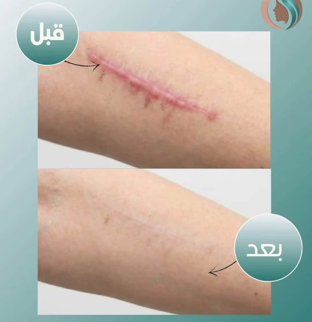 ✨ ودّعي آثار الجروح والعمليات القديمة ✨

ندب الجروح والعمليات ممكن تبقى لفترة طويلة وتأثر على مظهر البشرة، لكن مع ليزر CO2 Fractional نساعد على تحسين مظهر الندبات وتحفيز تجدد البشرة 🌿

🔹 علاج وتحسين مظهر الندب القديمة
🔹 آثار العمليات والجروح
🔹 تحفيز الكولاجين وتجدد البشرة
🔹 تحسين ملمس ومظهر الجلد
🔹 النتيجة تتحسن تدريجياً مع الجلسات حسب حالة الندبة

📍 عيادة Evora Clinic
📞 ***********
📌 حي الجامعة – قرب صيدلية السوسن
@إشارة

نص مكتوب في الصور:
- قبل علاج الندبات بالليزر بعد
- قبل بعد نتائج علاج آثار العمليات الجراحيه بالليزر
- قبل بعد