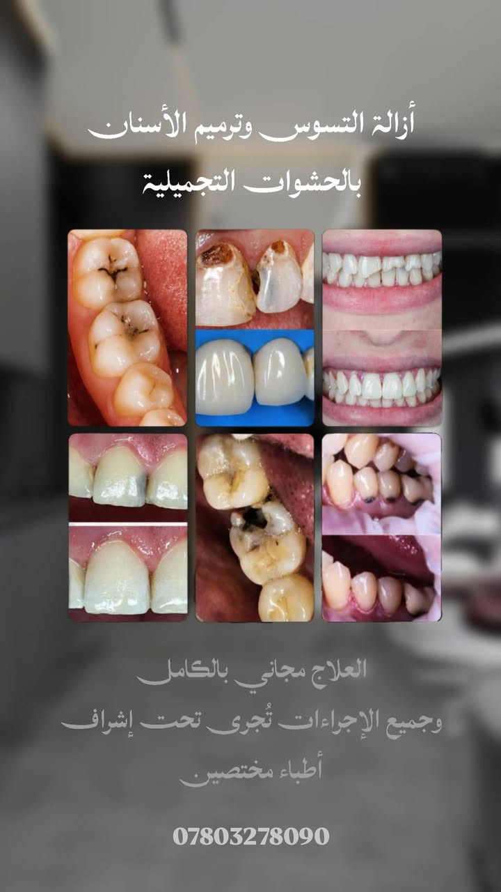 عـلاج الأسنان بالمجـان 
اي شخص يحتاج حشوات تجميلية دائمية 
قلع الأسنان والجذور التالفة
تنظيف اسنان وازالة التكلسات 
تعويض الأسنان المفقودة بطقم جزئي 

يتواصل ويانه ***********
العـلاج يكون مجـانـي بالكـامل وتحت إشـراف أطبـاء مختـصين 

العنوان / ناصرية - شارع النيل - بحي الشهداء - جامعة العين - مستشفى العين لطب الأسنان

نص مكتوب في الصور:
- تنظيف الأسنان وأزالة التكلسات والتصبغات العلاج مجاني بالكامل وجميع الإجراءات تُجرى تحت إشراف أطباء مختصين ***********
- قلع الأسنان والجذور الغير قابلة للعلاج العلاج مجاني بالكامل وجميع الإجراءات تُجرى تحت إشراف أطباء مختصين ***********
- أزالة التسوس وترميم الأسنان بالحشوات التجميلية العلاج مجاني بالكامل وجميع الإجراءات تُجرى تحت إشراف أطباء مختصين ***********
- تعويض الأسنان بطقم جزئي أو كامل متحرك العلاج مجاني بالكامل وجميع الإجراءات تُجرى تحت إشراف أطباء مختصين ***********