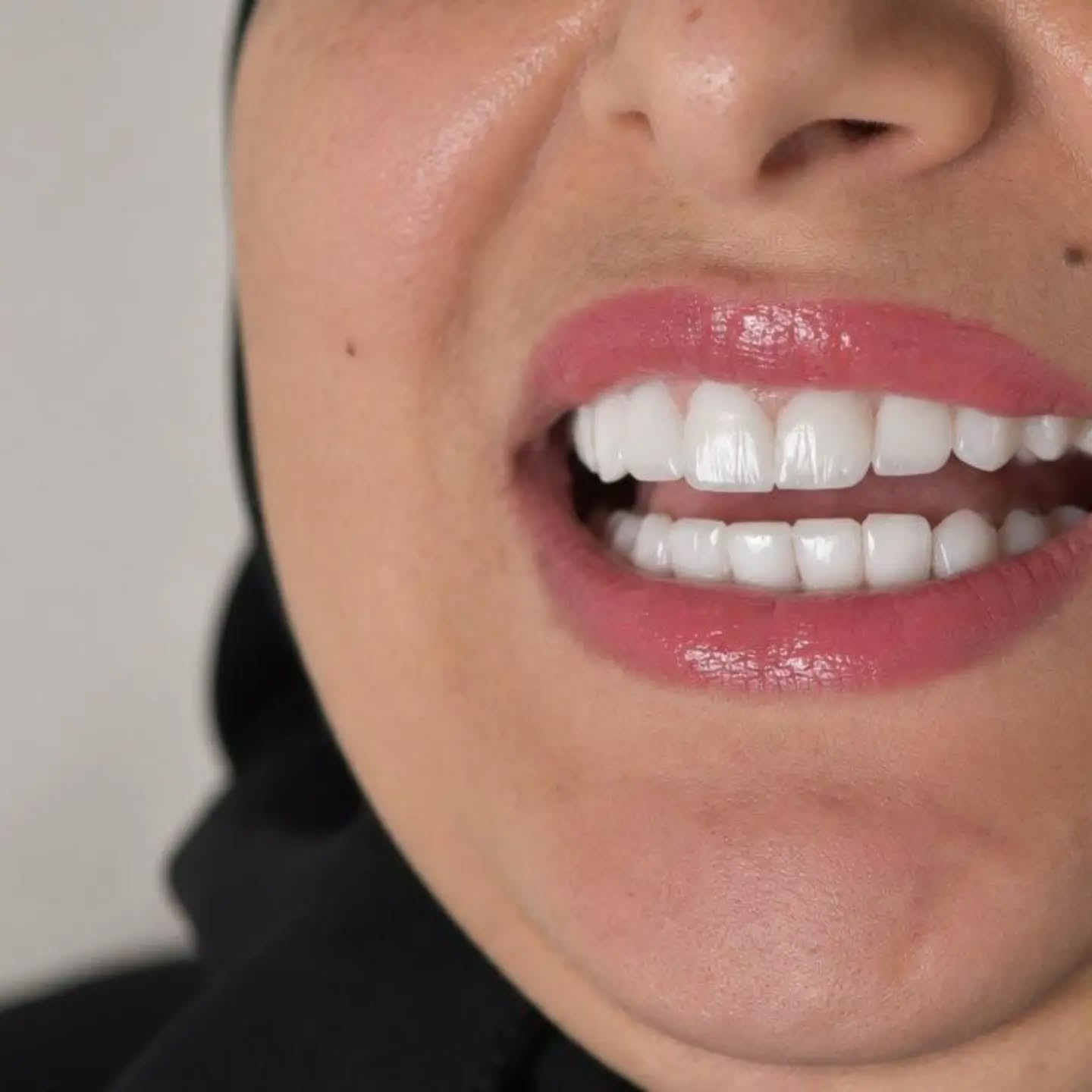 ابتسامتك تستحق تكون اجمل تخلصي من التصبغات واصفرار الاسنان وحصلي على ابتسامة اكثر اشراقة وثقة 🦷🩵
