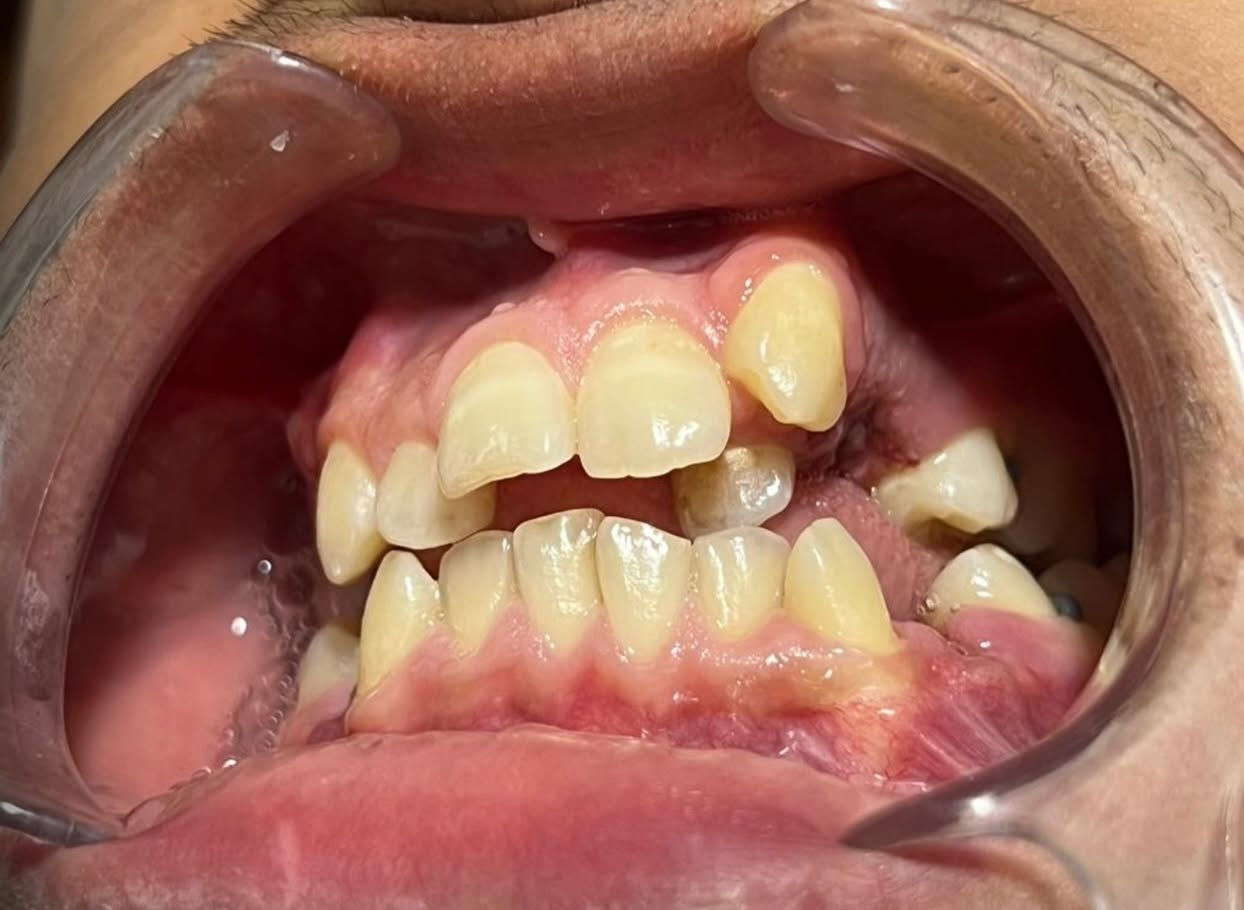 التقويم يميزنا احد اعقد و اصعب الحالات عدم انتظام و ازدحام شديد في ترتيب الاسنان ماشالله الوصول الى مراحل شبه نهائية الصور تتكلم …. علاج جميع الحالات الصعبة و المعقدة نتائج مضمونة خبرة طويلة في مجال الحالات المعقدة دقة طبية في التعامل ابتسامة مثاليه اسعار مناسبة بالتقسيط المريح… دكتور غزوان مزهر بغداد الكرخ نفق الشرطة بداية شارع الاطباء عيادة لوركا فوق صيدلية كنز النفق متوفر واتس *********** #تقويم_الاسنان #تقدم_الفك_السفلي #تقويم_الشفاف #تقويم_الدايمون #زراعة_الاسنان @تغليف_الاسنان_الزاركون
