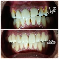 زاركون • ارجاع ابتسامة • تغليف خاطئ
