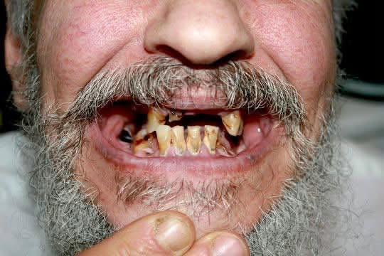 قلع أسنان • أسنان لبنية • مجاني