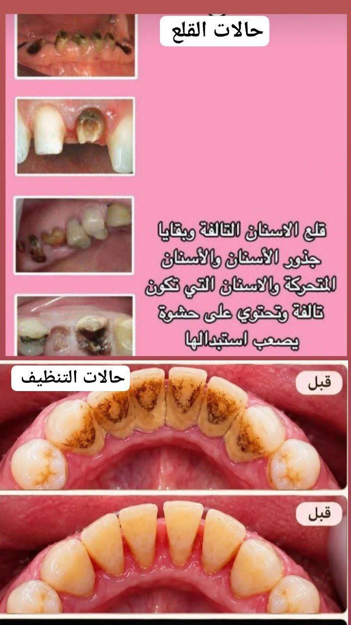 علاج اسنان مجاني • عيادات الجامعة الوطنية • قلع اسنان