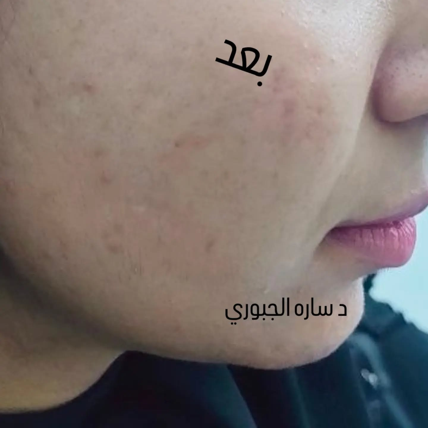 د. ساره الجبوري

نص مكتوب في الصور:
- قبل
- بعد
- د ساره الجبوري
