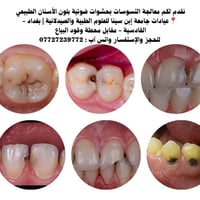 حشوات ضوئية • علاج تسوس • عيادات ابن سينا