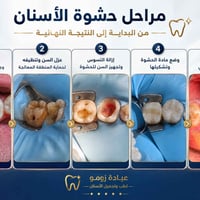 حشوة السن • عيادة زومو • المحمودية