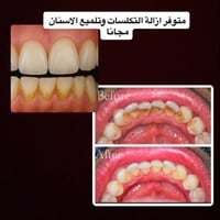 مجاني • ازالة التكلسات • داخل عيادات الجامعة