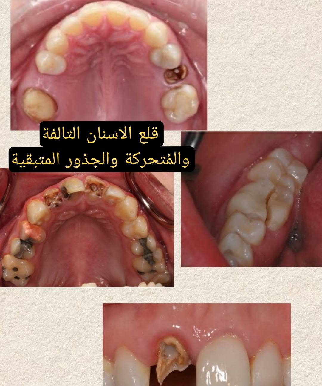 السلام عليكم ♥️♥️متوفر علاج مجاني بالكامل اللي عنده حشوة تنظيف وقلع تعويض اسنان وتحت أشراف مجموعة من الاستاذة النخبة الاختصاص في عيادات جامعة دجلة 
للتفاصيل اكثر واتساب +9647762435273

نص مكتوب في الصور:
- تنظيف وازالة التكلسات
- Class 1 حشوات تجميلية دائمة
- قلع الاسنان التالفة والمتحركة والجذور المتبقية
- تعويض الاسنان باطقم جزئية