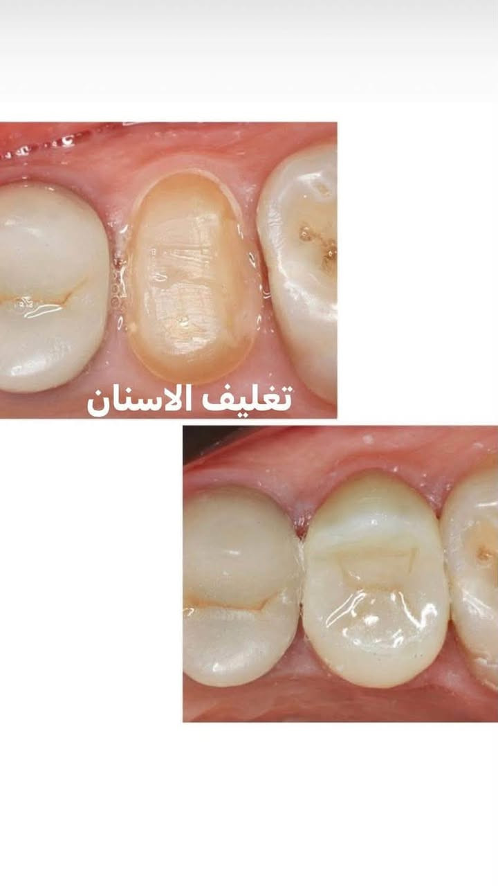 اللي يريد يحجز يتصل او يدز عالخاص
عيادة طب الاسنان 
تقويم الاسنان ،، زراعة الاسنان ،، حشوات تجميلية
تركيب الاسنان (سيراميك و زارگون)،، حشوات جذور ،، قلع،، حشوات مؤقتة ودائمية ،، تنظيف وتلميع الاسنان ،، تبييض الاسنان بالليزر 
متواجدين طيلة أيام الاسبوع 
للحجز والاستفسار ع الخاص او ع الرقم 
*********** واتساب 
العنوان .. الامين الثانية شارع البنازيخانة يم السوگ 
قریب ع افران السلام واسواق الشارقة مقابل محلات الصبيحاوي
مجمع دكتورة رجاء محمد نصيري
