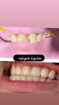 تركيب أسنان • حشوات أسنان • مجمع السياب
