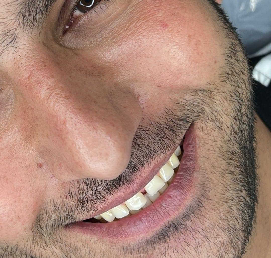 ✨ ابتسامة بدون برد... لأن الثقة تبدأ بابتسامة طبيعية.

ابتسامة متناسقة، مظهر طبيعي، ونتائج مصممة بما يناسب كل حالة.

📍عيادة د. هند الحسيني
📞 ***********

احجز موعدك واستفسر عن الخيار الأنسب لابتسامتك.

#ابتسامة_بدون_برد #عدسات_الأسنان #طب_الأسنان #ابتسامة_طبيعية #قبل_وبعد #بغداد
