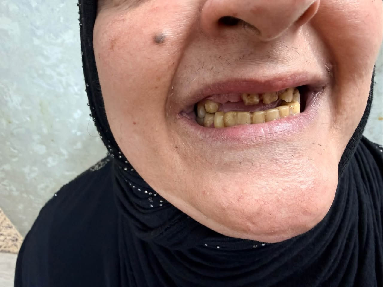 تعلن عيادة بلاتين لطب الأسنان و التجميل عن خصومات بنسبه ٤٠ ٪؜ لفترة محدوده 🎉🎉
تخفيضات على الفلر و البوتوكس و ابر النضاره 

تخفيضات على كافه انواع الابتسامات و الزراعه و الحشوات و تنظيف الاسنان

للاستفسار و الحجز على الرقم 

 ***********
***********

العنوان : شارع شهداء البياع العام -مقابل مطعم دجاج العبيدي- مجمع بلاتين التخصصي
