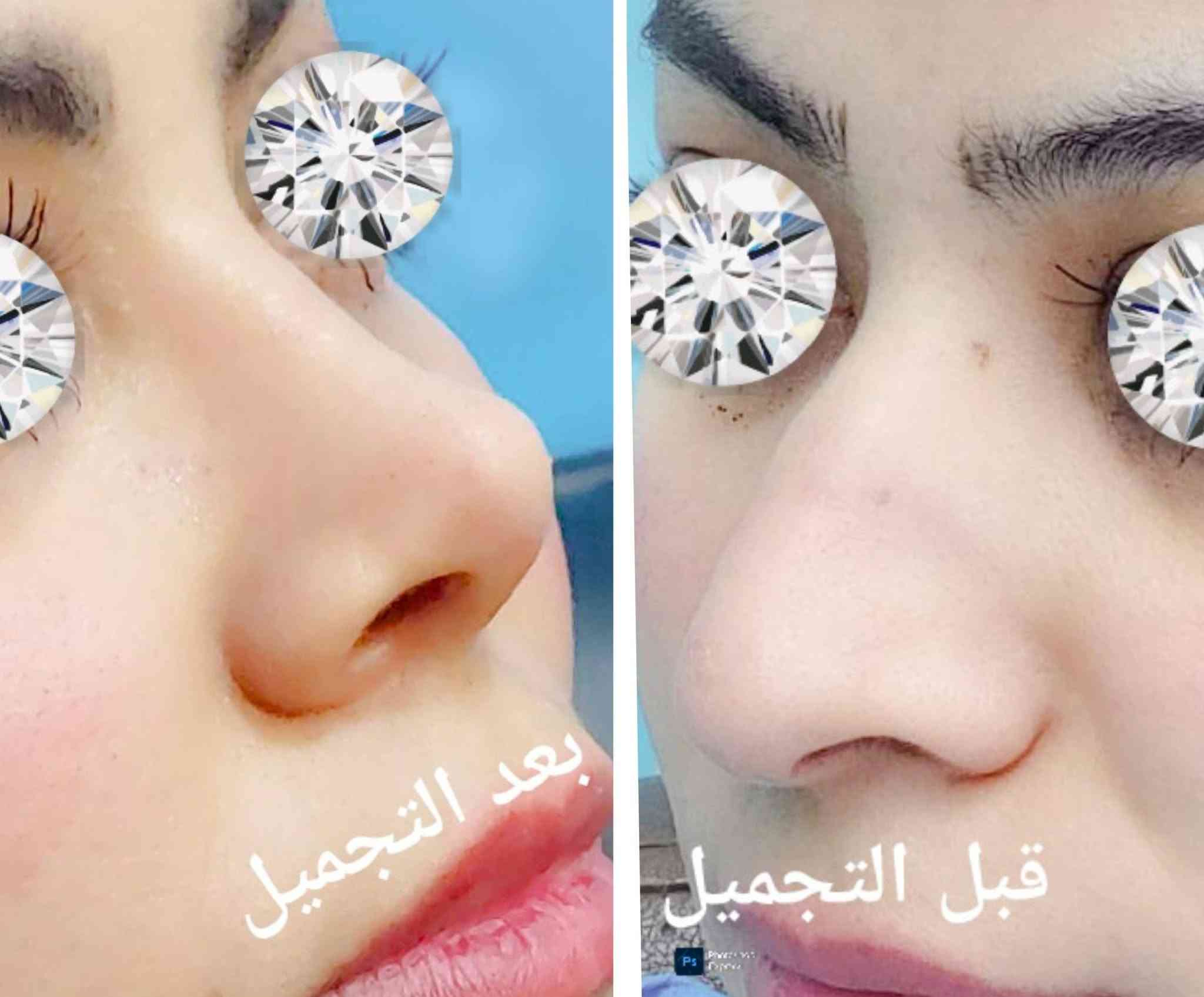 تجميل أنف • قبل وبعد • عيادة الياسري