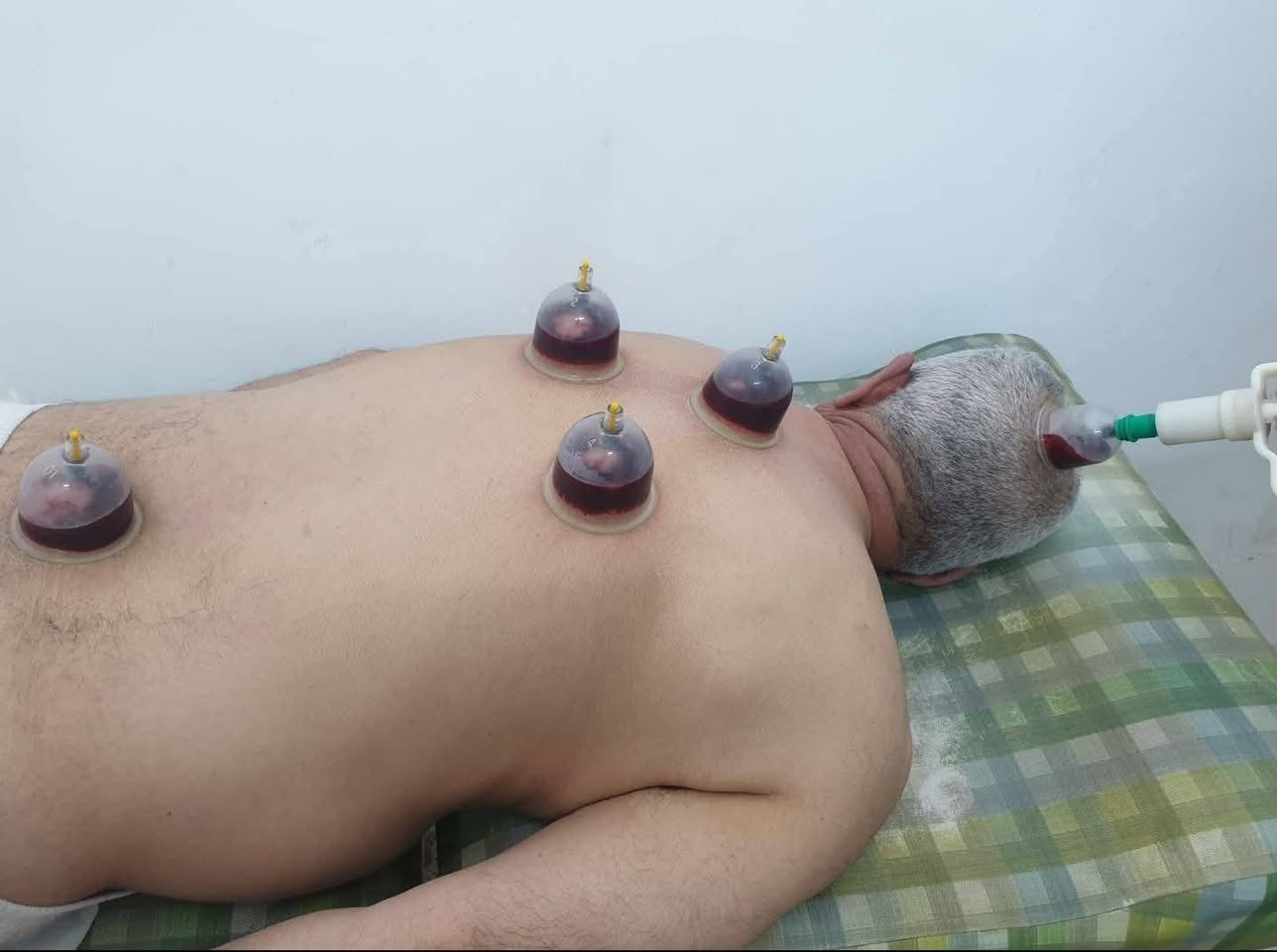 حجامة دموية • حجامة جافة • مساج
