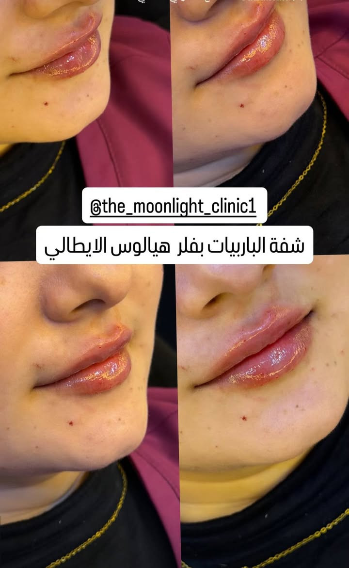 فيلر شفايف • هيالوس ايطالي • د ضحى حسين گمر