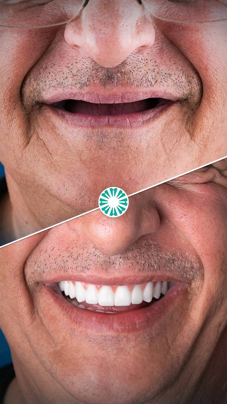 🚨🦷 خدمات أسنان مجــــانــــًا بالكامل! 🦷🚨

🎁 فرصة للاستفادة من خدمات طب الأسنان مجانًا:

🦷 طقم أسنان كامل للفك العلوي والسفلي — مجانًا
✨ حشوات ضوئية تجميلية للأسنان الأمامية — مجانًا
🦷 قلع الأسنان — مجانًا
🪥 تنظيف وإزالة تكلسات الأسنان — مجانًا

💥 نعم، الخدمات المذكورة أعلاه مجــــانــــيــــة!

📍 كربلاء – شارع الحر الصغير
🏥 عيادات أهل البيت التخصصية

📞 للحجز والاستفسار:
***********

⏳ الحجز مسبقًا والأماكن محدودة.