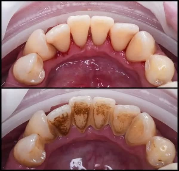 متوفر علاج مجاني💗!

تنظيف اسنان وإزالة التكلسات .
حشوات ضوئية تجميلية .
وقلع الاسنان والجذور المتبقية .
تعويض الاسنان المفقودة الخلفية بطقم .

الي يحتاج يعلق او يدخل خاص 
العنوان جامعة النور ، مقابل دجلة ستي

نص مكتوب في الصور:
- كلاس لطيب الأسنان *********** - *********** بغداد - زيونة - شارع الربيعي - مقابل قطار