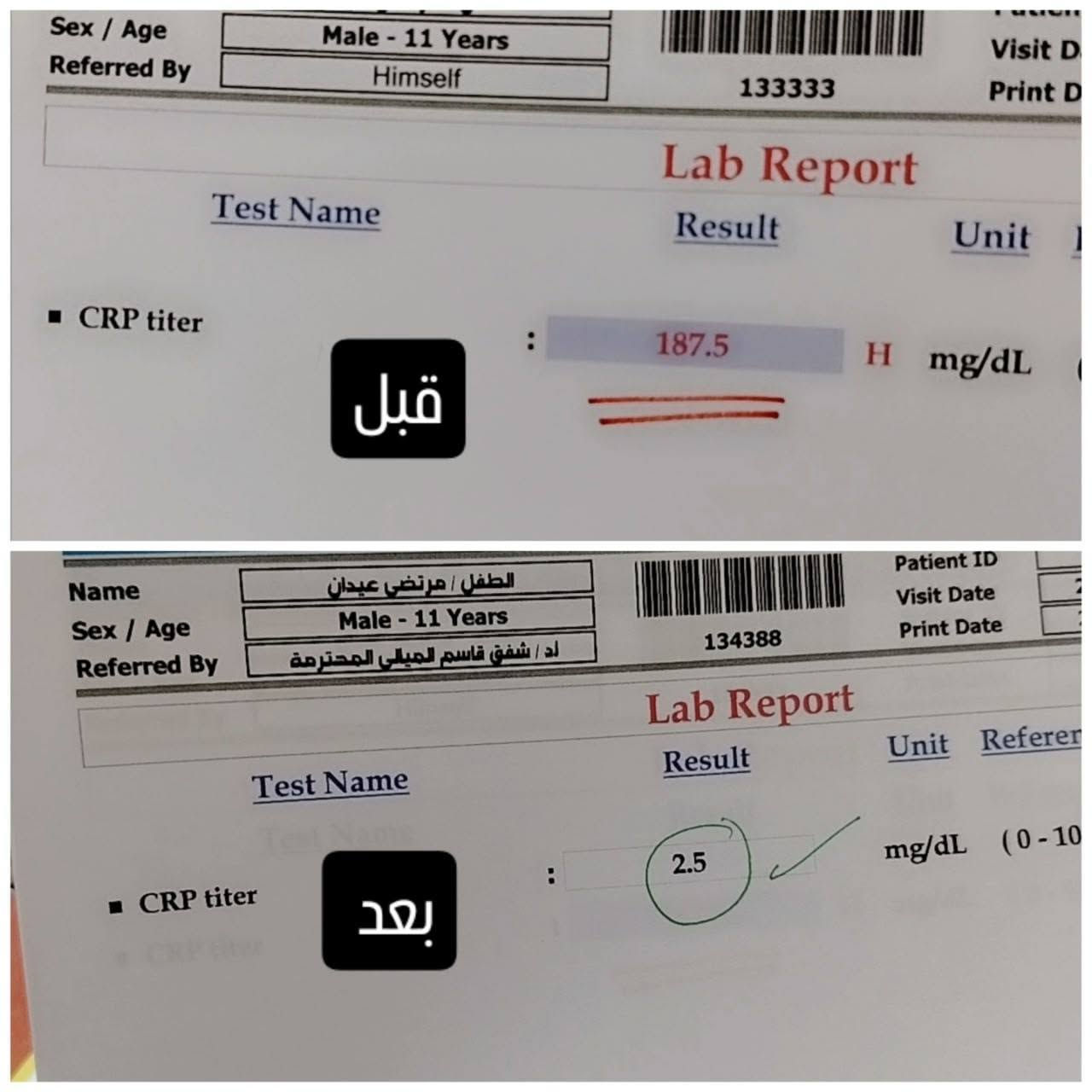 طفل عمره 11 سنة، استمرت عنده الحمى أكثر من 12 يوم، وياها تشقق بالشفايف، تقشر بالأطراف، طفح جلدي وتضخم بعقدة لمفاوية بالرقبة.
بالفحوصات: CRP: 187 | ESR: 55  ____ 771/ Platelets 
وبعد الفحص السريري وإجراء إيكو للقلب، صار عدنا اشتباه قوي بمرض كاواساكي.
تم البدء بالعلاج المناسب والمتابعة الدقيقة، والحمد لله كانت الاستجابة ممتازة؛
#عيادة #الدكتورة #شفق #قاسم #مجيد #الميالي 
اختصاص البورد العراقي في طب الأطفال وحديثي الولاده
الحمزة الشرقي شارع الأطباء مجمع اوزون الطبي O3 
 رقم الحجز ***********
