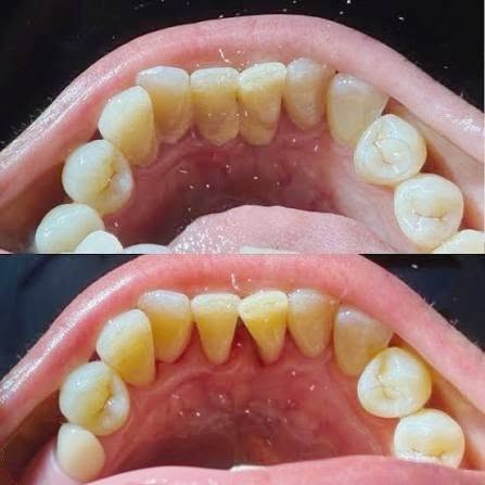 🦷 تحتاج علاج أسنان؟ نوفر لك العلاج داخل العيادة الجامعية

تتوفر حاليًا إمكانية استقبال المرضى لعلاج عدد من حالات الأسنان، بإشراف أطباء وأساتذة الاختصاص.

🔹 تنظيف وتبيض الأسنان
🔹 حشوات الأسنان الخلفية لكافة انواع تسوس 
🔹 حشوات تجميلية لعلاج كسر او تسوس الاسنان الامامية. 
🔹 علاج أسنان الأطفال
🔹فحص و علاج امراض اللثة والفم
🔹 خلع الأسنان عند الحاجة
🔹 تخم الأسنان المتحرك اذا كنت فاقد جميع الاسنان . 
🔹 حالات أخرى بعد الفحص والتقييم

📍 المكان: المستشفى التعليمي – كلية طب الأسنان جامعة بلاد الرافدين - بعقوبة -قرب تقاطع القدس. 

💰 العلاج: مجاني فقط سعر الباص. 

إذا كنت تحتاج علاجًا أو تعرف شخصًا يحتاجه، ضمن الصور المرفقة راسلنا على الخاص وأرسل:
📸 صورة الأسنان إن أمكن
📍 المنطقة
📞 رقم للتواصل

الأولوية للحالات المناسبة للإجراءات المتوفرة حاليًا.

🦷 صحتك تبدأ بخطوة بسيطة… احجز موعدك للفحص.

نص مكتوب في الصور:
- كلية طب الاسنان جامعة بلاد الرافدين رعاية متكاملة لصحة الفم والاسنان خدماتنا حشوات تجميلية وعلاج التسوس تنضيف و تلميع الأسنان قلع الاسنان علاج أسنان الأطفال صناعة وتركيب اطقم أسنان للحجز *********** ديالي,بعقوبة,قرب تقاطع القدس المستشفى التعليمي كلية طب الأسنان لجامعة بلاد الرافدين