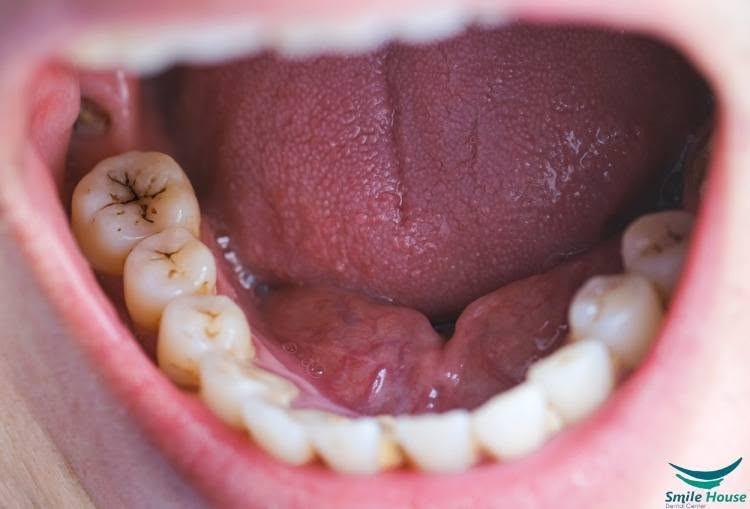 كلية طب الأسنان الموصل • أسعار رمزية • علاج تسوس